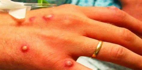 Criança de 11 anos em Parnamirim é o primeiro caso confirmado de varíola dos macacos nessa faixa etária no RN