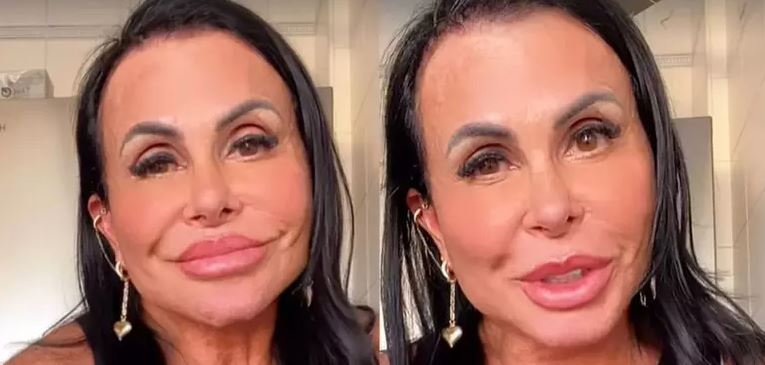 Após realizar harmonização facial, Gretchen é criticada na web e rebate: “A cara é de quem?”