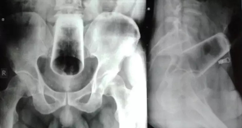 Homem fica com copo preso no ânus por 3 dias e passa por cirurgia: “estava embriagado”