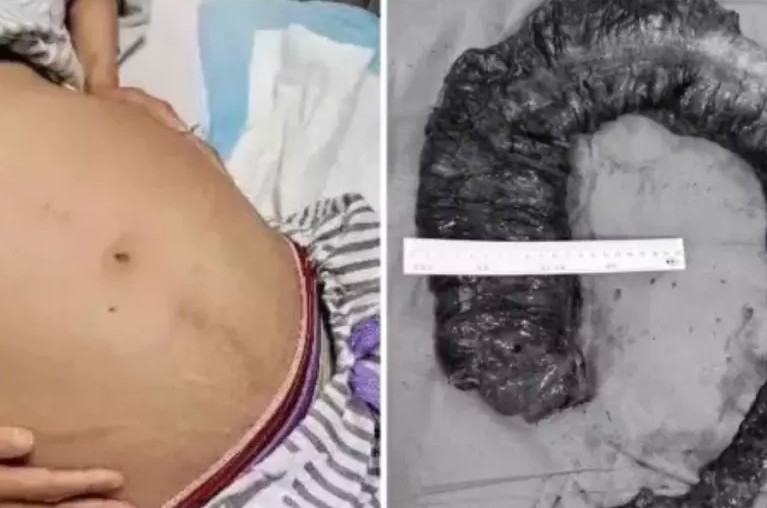 BIZARRO: Mulher passa por cirurgia de emergência após 10 dias sem evacuar; médicos retiraram 20 quilos de fezes