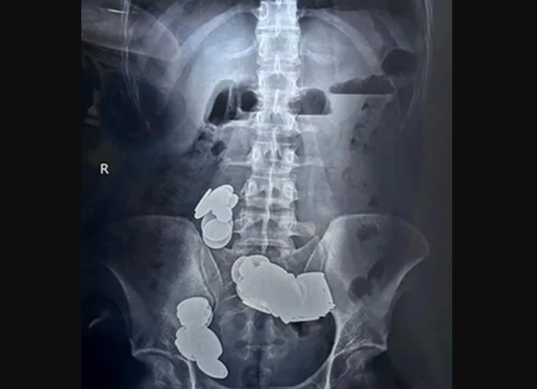 Médicos retiram 39 moedas e 37 ímãs do intestino de fisiculturista que os engoliu para ‘absorver zinco’