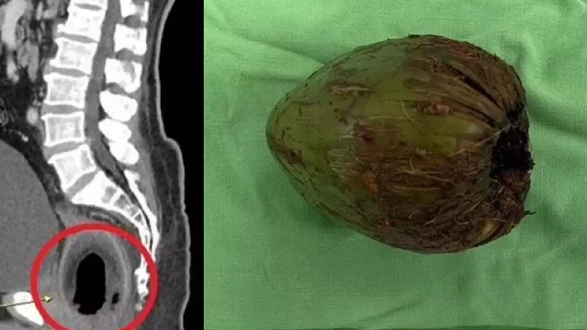 Bizarro: Cirurgiões removem coco verde de 9 cm do ânus de homem em Taiwan
