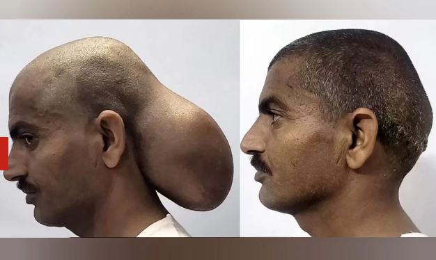 Homem tira tumor do tamanho de um melão da cabeça após 15 anos com ele