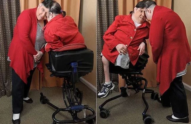 Gêmeos siameses mais longevos morrem aos 62 anos; confira sua história