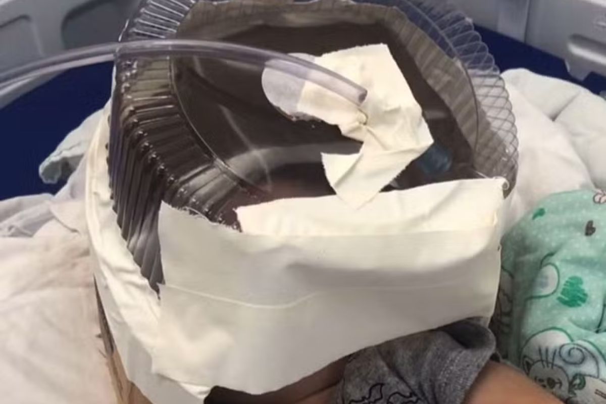 Bebê que teve embalagem de bolo usada como máscara de oxigênio recebe alta da UTI