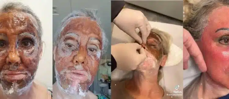 Deputados protocolam projeto de lei para regulamentar peeling de fenol