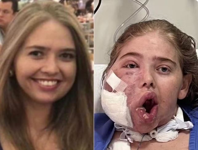 Potiguar que lutava contra tumor gigante no rosto morre em decorrência de infecções