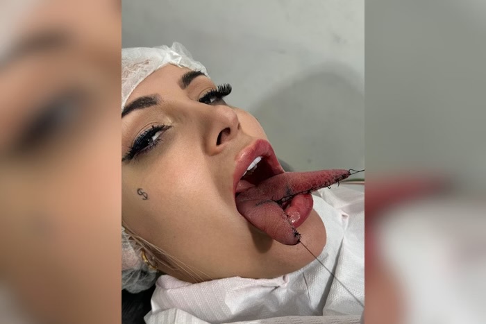 Veja detalhes da polêmica cirurgia feita por Andressa Urach