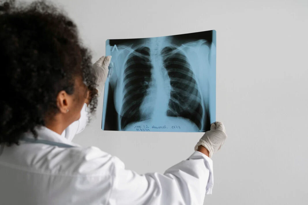 Câncer de pulmão é o 4° tumor que mais atinge pessoas no RN