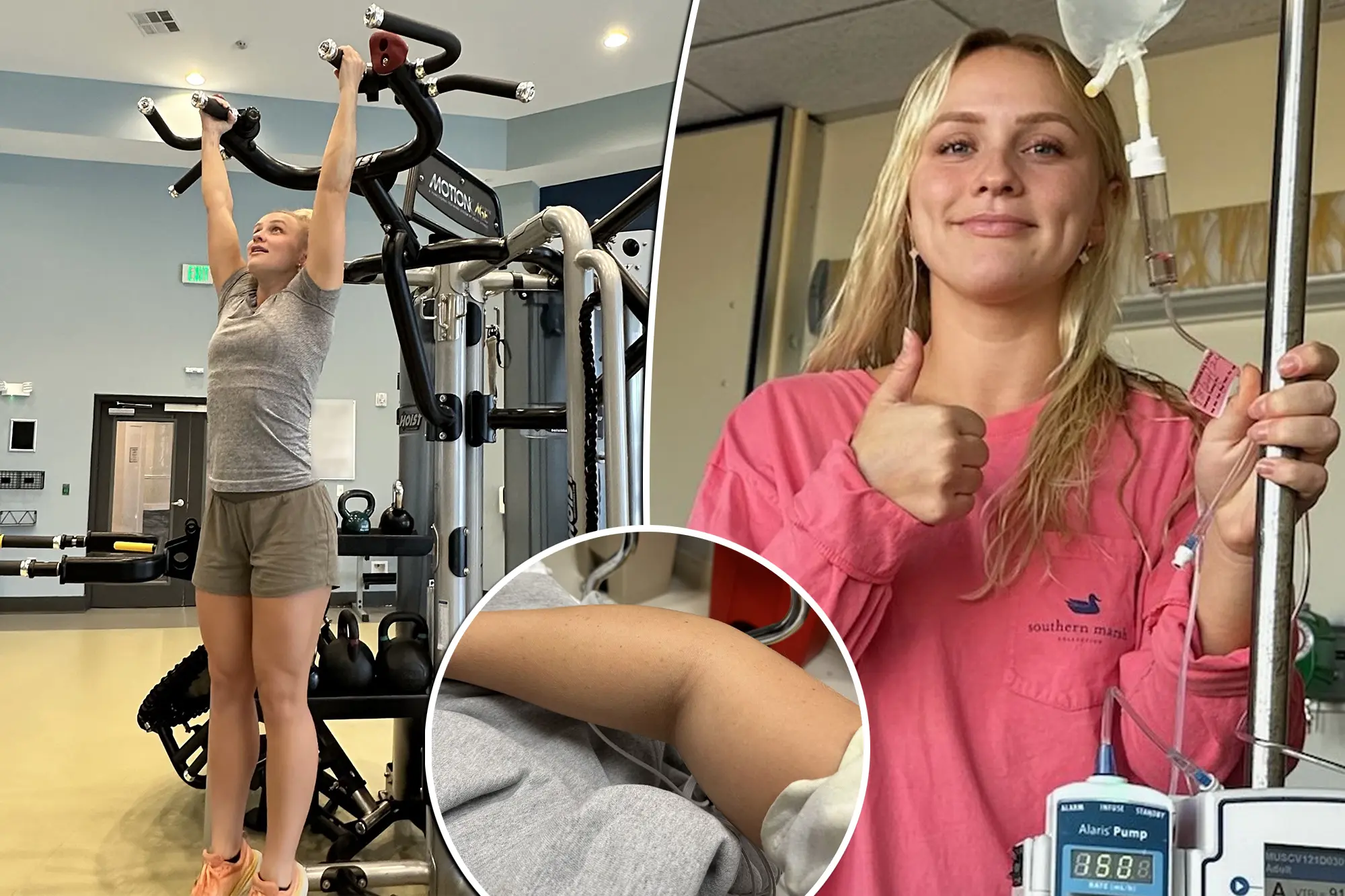 Caso inusitado: músculos de mulher ‘explodem’ após treinamento intenso para desafio de CrossFit; entenda