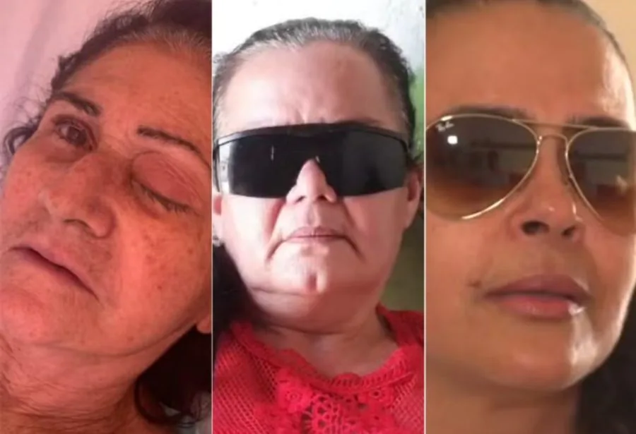 Sobe para 10 número de pacientes que perderam globo ocular após infecção em mutirão de catarata no RN