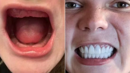 Jovem perde os dentes após procedimento estético e vai desembolsar R$ 280 mil para implantes