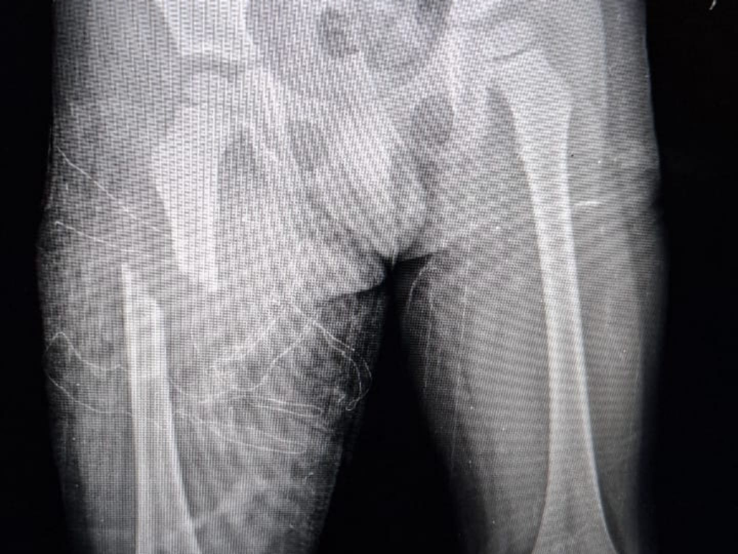 Criança atropelada por motorista embriagado em Parnamirim pode ficar sem a perna, lamenta pai