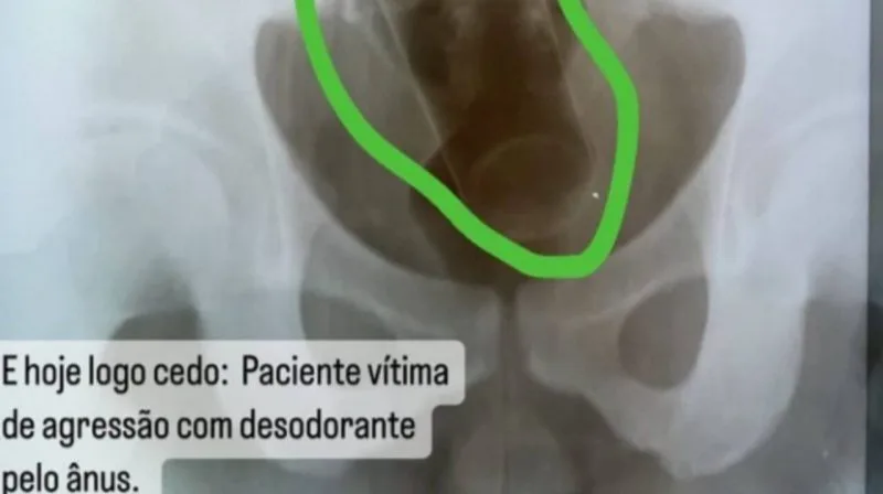 DEU RUIM: Prefeitura na Paraíba demite médico por vazar raio-x de paciente com desodorante no ânus