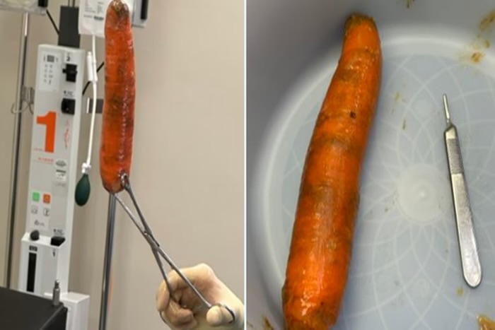 SURREAL: Homem vai parar na emergência com “cenourão” enfiado no ânus