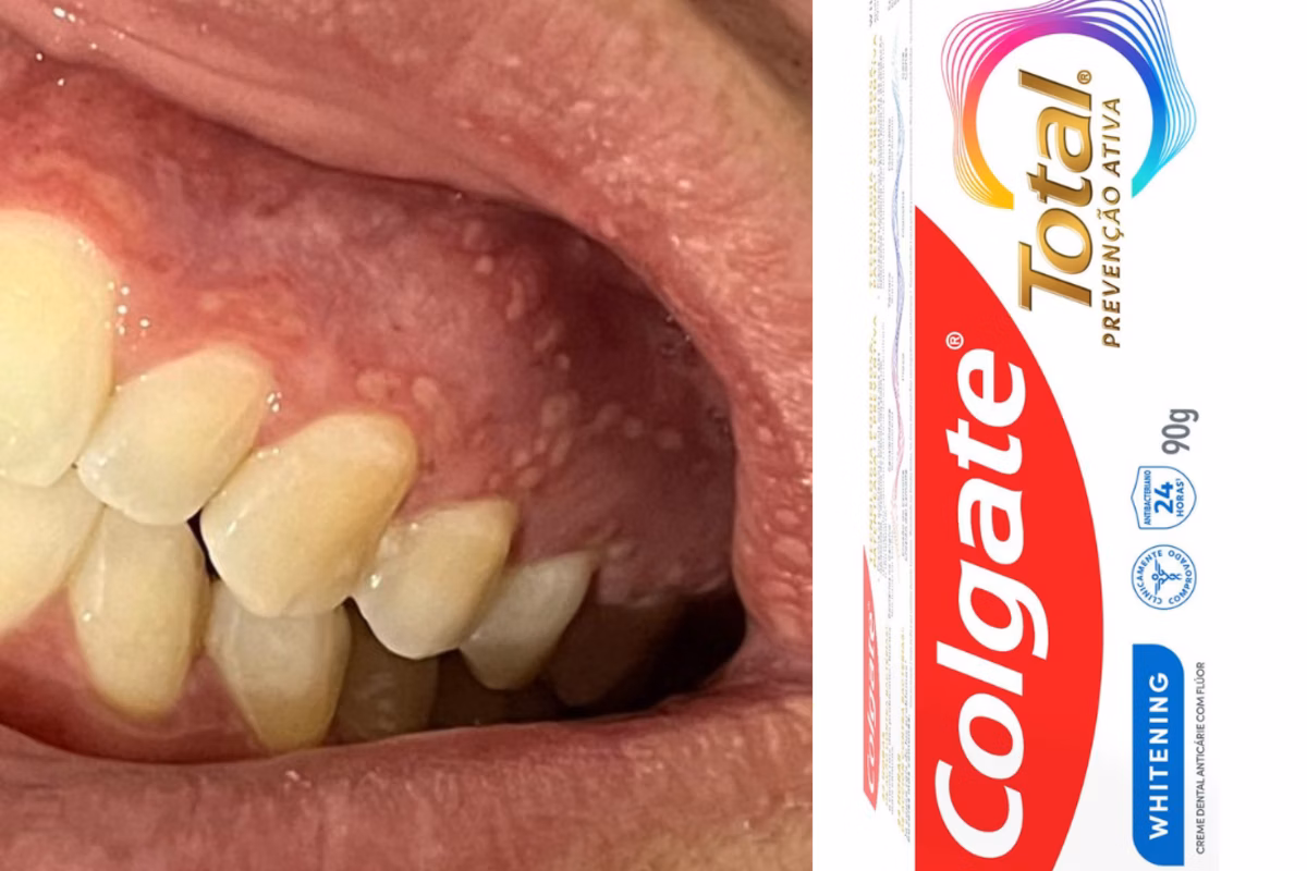 Anvisa monitora lesões e inflamações após nova fórmula de creme dental da Colgate