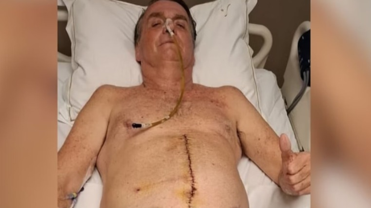 Ex-presidente Bolsonaro posta foto da barriga aberta com intestino à mostra; IMAGEM FORTE