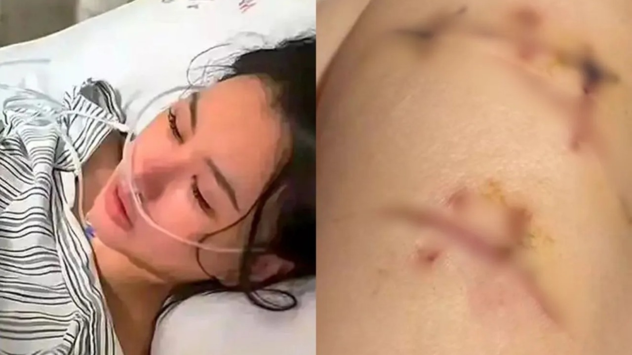 Mulher sobrevive a 22 facadas no peito graças a implante de silicone