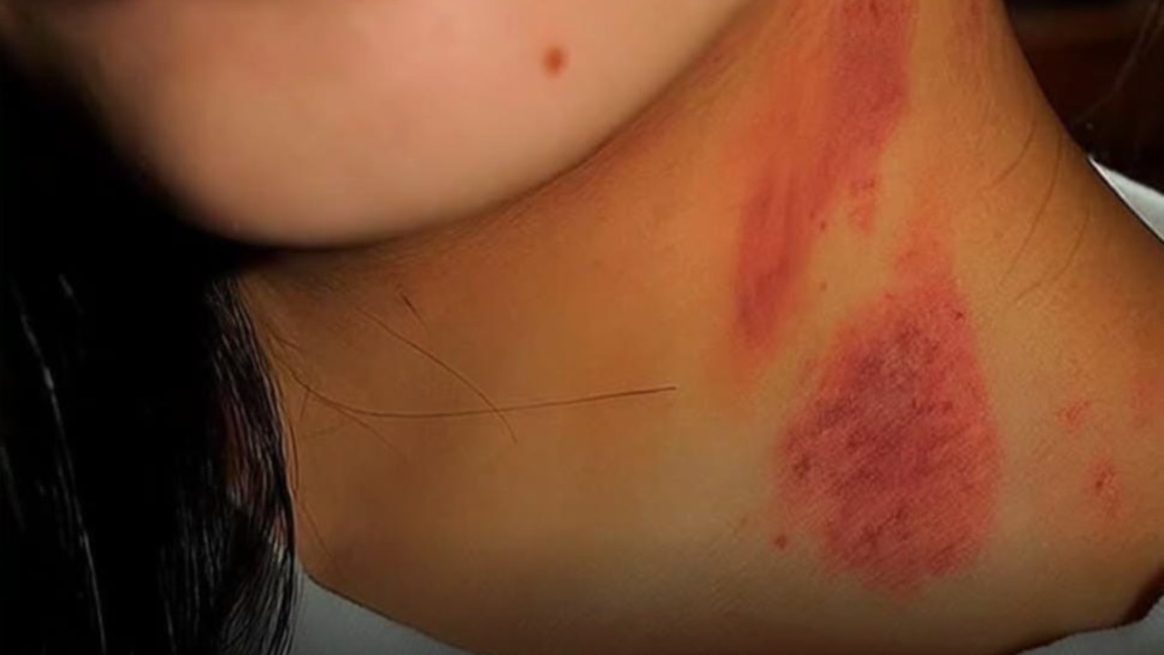 Mulher volta para casa com marca no pescoço e diz ao marido ter sofrido suposto ataque de lobisomem em Goianinha