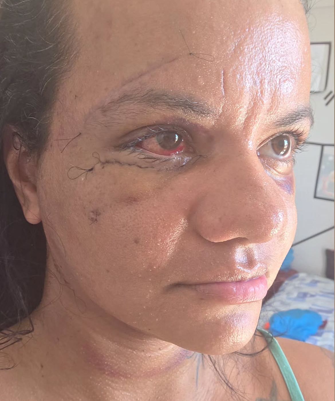 Após levar 61 socos no elevador, Juliana Soares mostra rosto 7 dias após cirurgia reparadora
