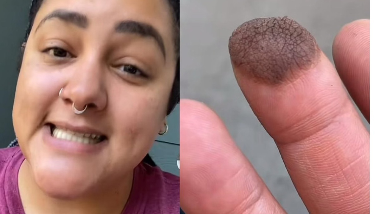 Mulher precisa depilar dedo após fazer enxerto com pele da virilha