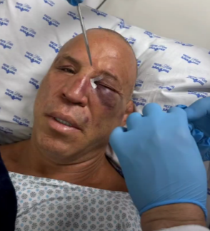 Nocauteado após a luta: veja como ficou rosto de Wanderlei após briga com equipe de Popó