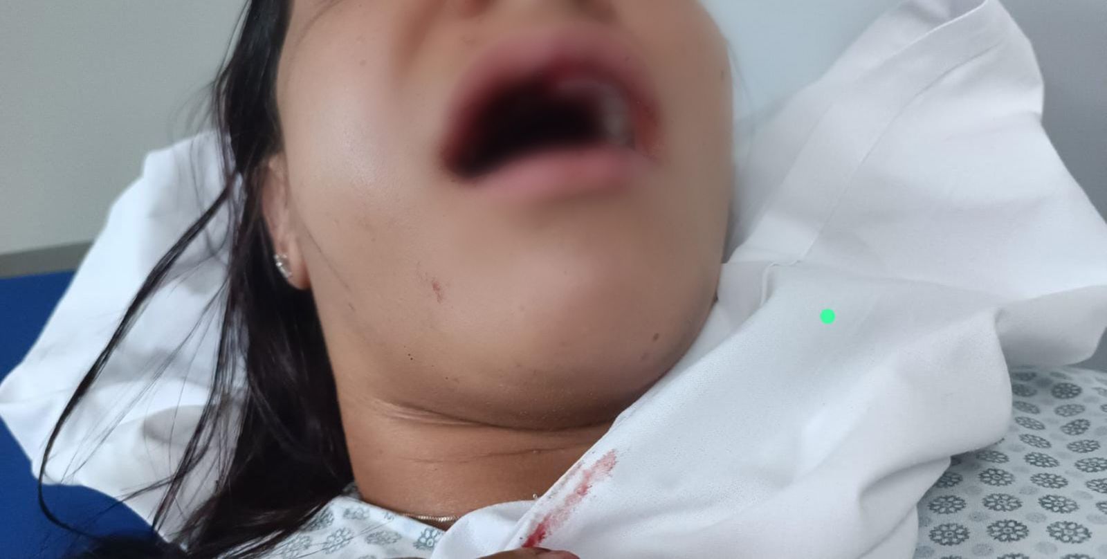 Mulher sofre fratura no rosto e perde dentes após ataque do ex em Parnamirim