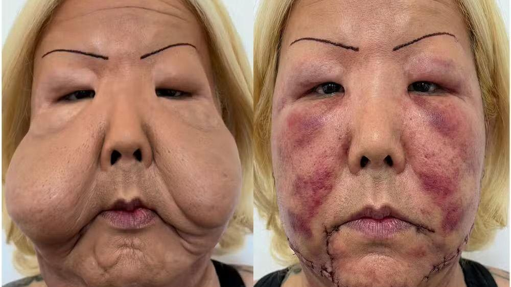 Quem é Juju do Pix, influenciadora que passou por cirurgia após complicações de procedimento estético clandestino