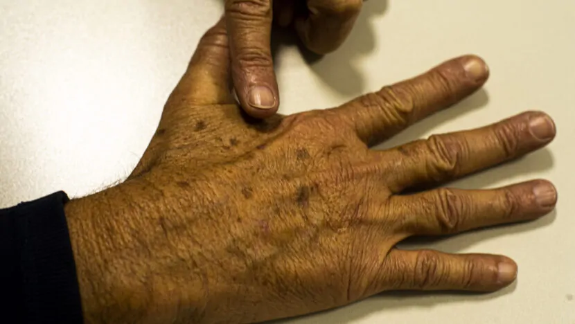 Natal terá mutirão de dermatologistas contra câncer de pele neste sábado 13