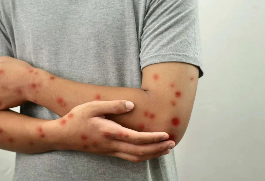 Sesap confirma primeiros casos de mpox no RN em 2026