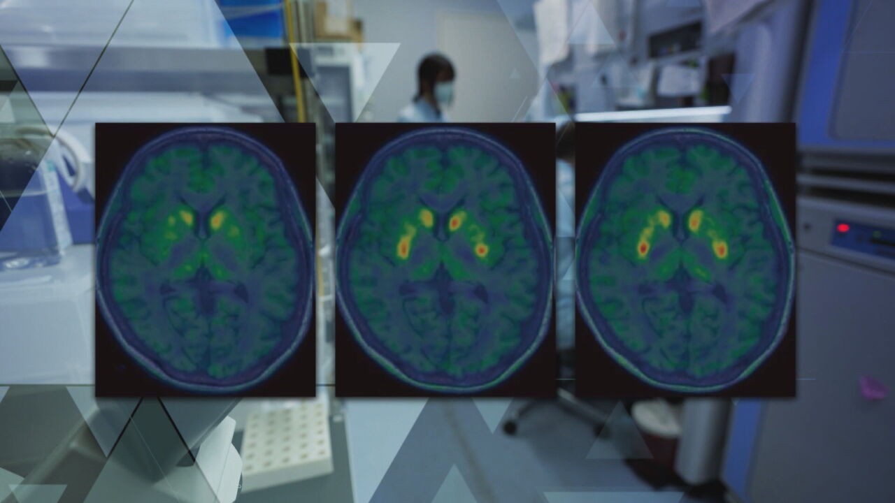 Avanço no Parkinson: Células-tronco podem restaurar dopamina no cérebro