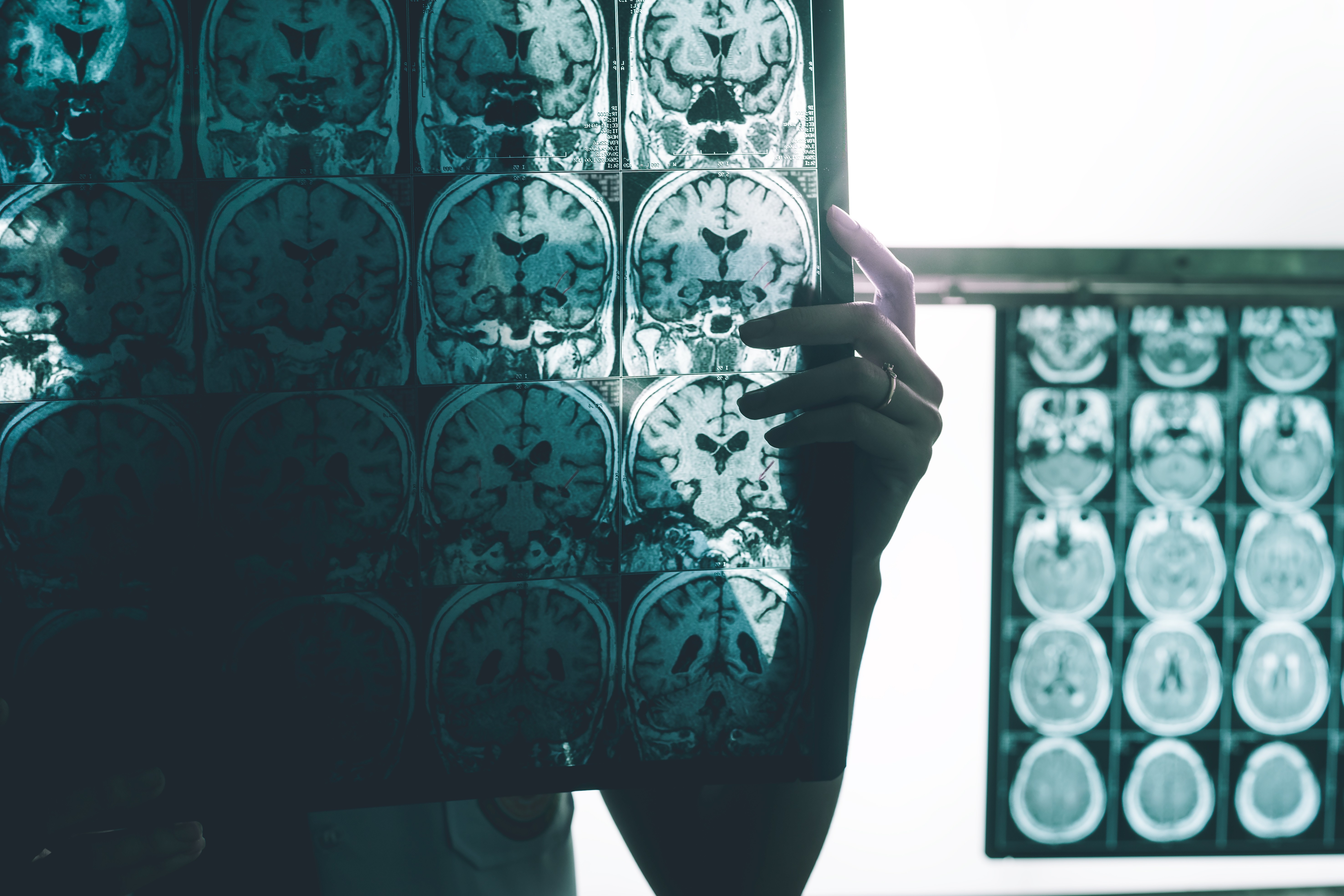 Células imunes do cérebro revelam potencial protetor contra o Alzheimer