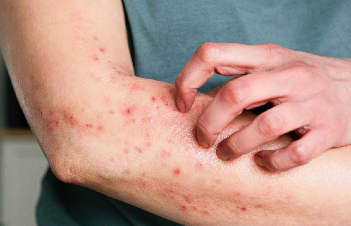 Sesap confirma três novos casos de Mpox no Rio Grande do Norte