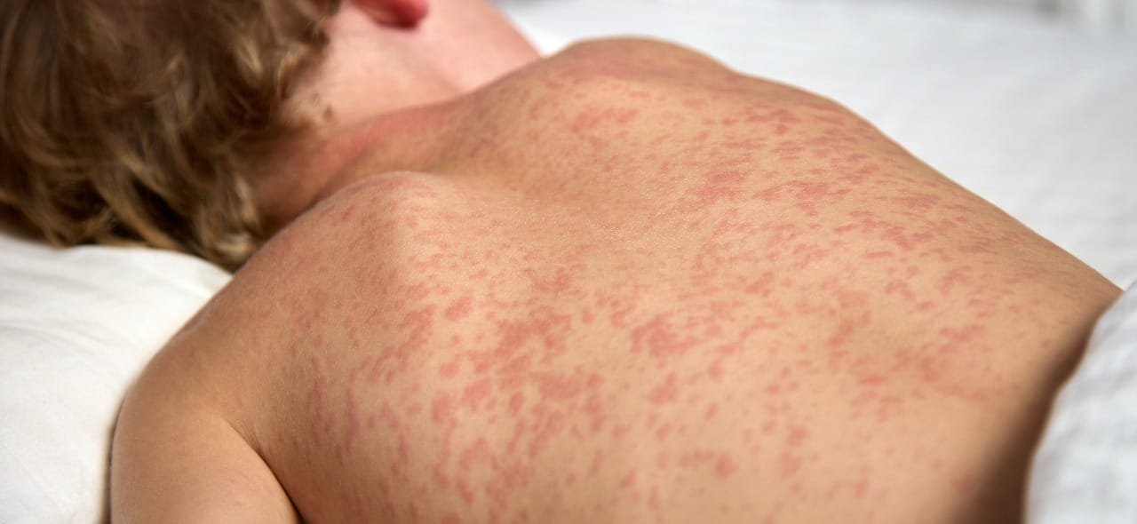 Sarampo acende alerta no Brasil e RN reforça a importância da vacina