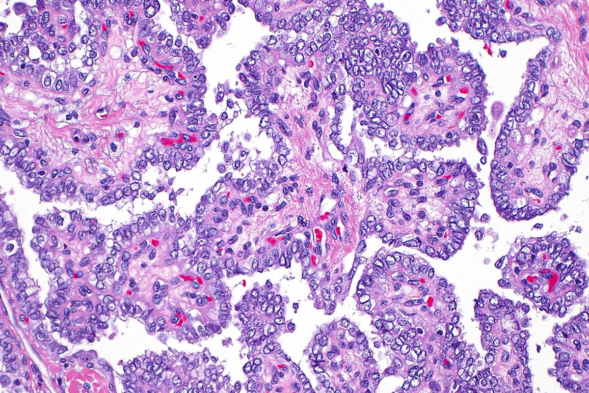 The Lancet alerta: câncer de cabeça e pescoço avança em mulheres