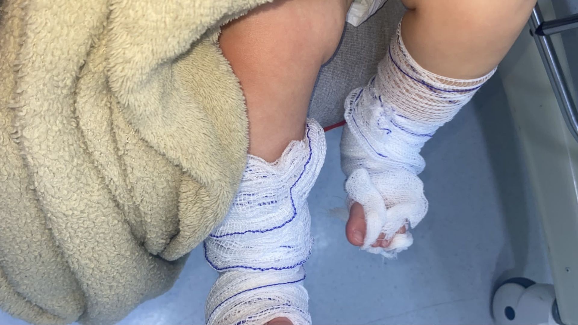 Bebê sofre queimaduras graves durante banho em Emei de Campo Bom
