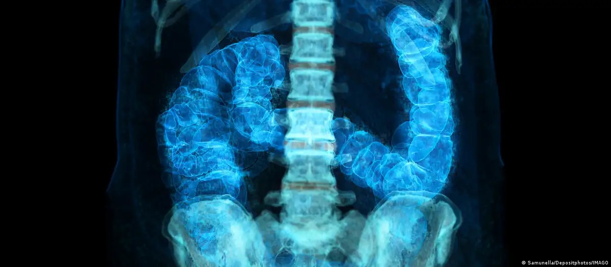 Diagnóstico precoce do câncer de intestino eleva chances de cura para 90%