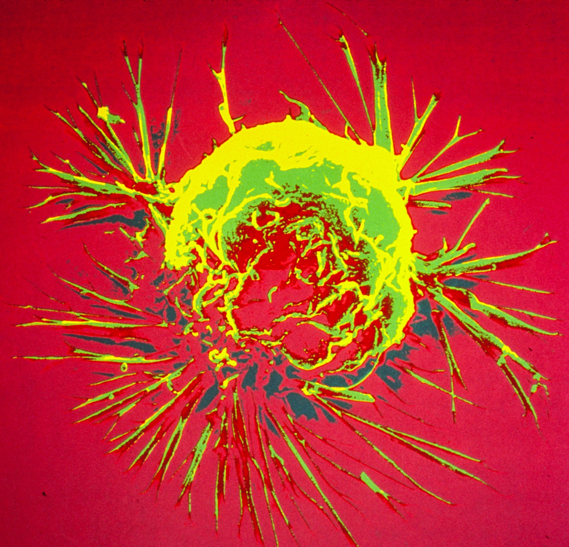 Cientistas modificam a bactéria Clostridium sporogenes para combater tumores