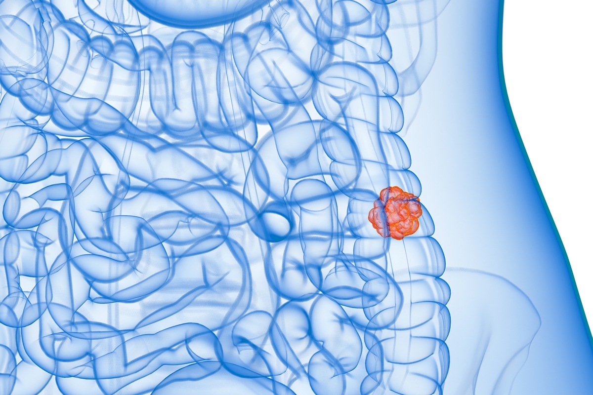 Pólipos intestinais: alteração silenciosa que pode evoluir para câncer