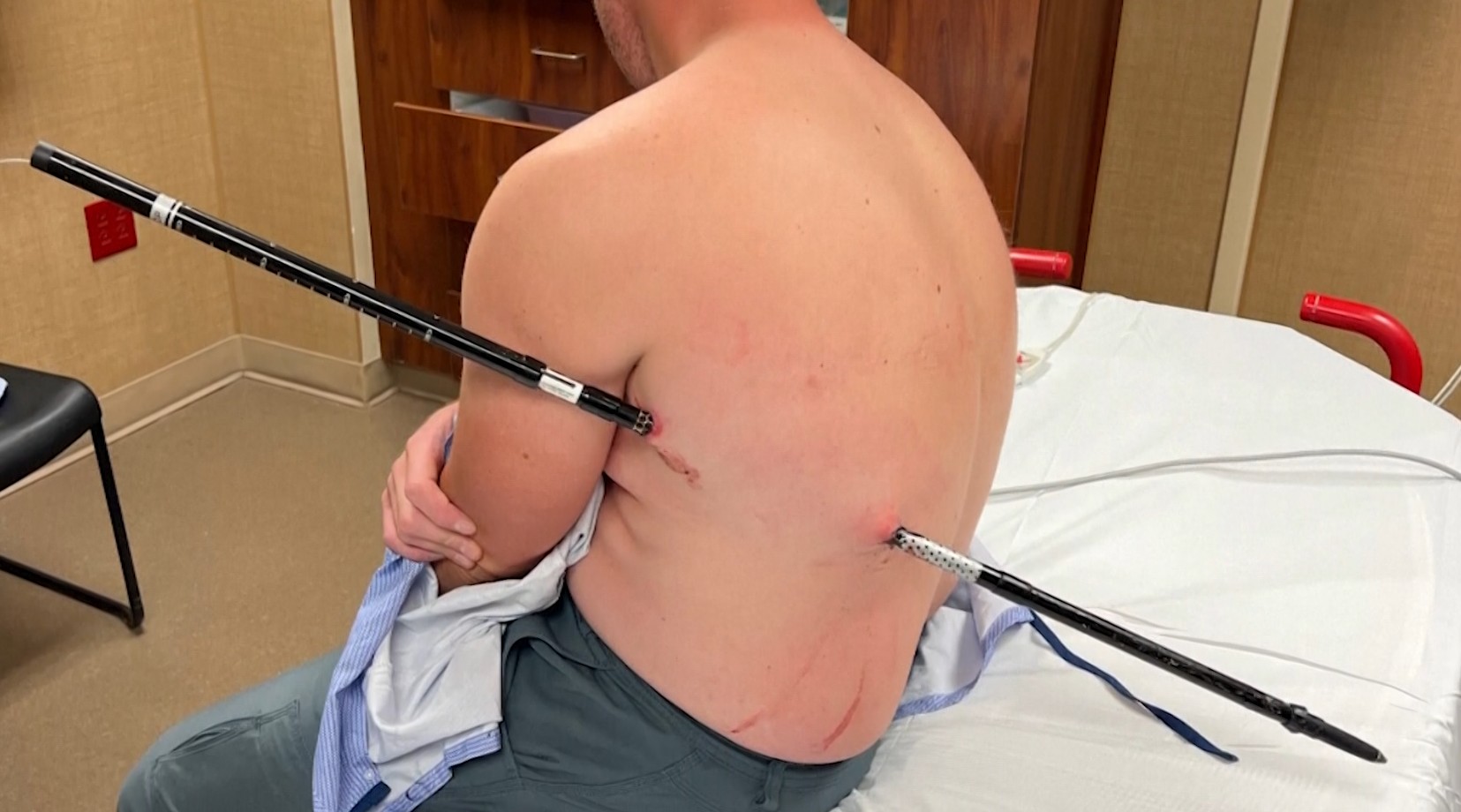 Enfermeiro sobrevive após caminhar 16 km com bastão atravessado no corpo