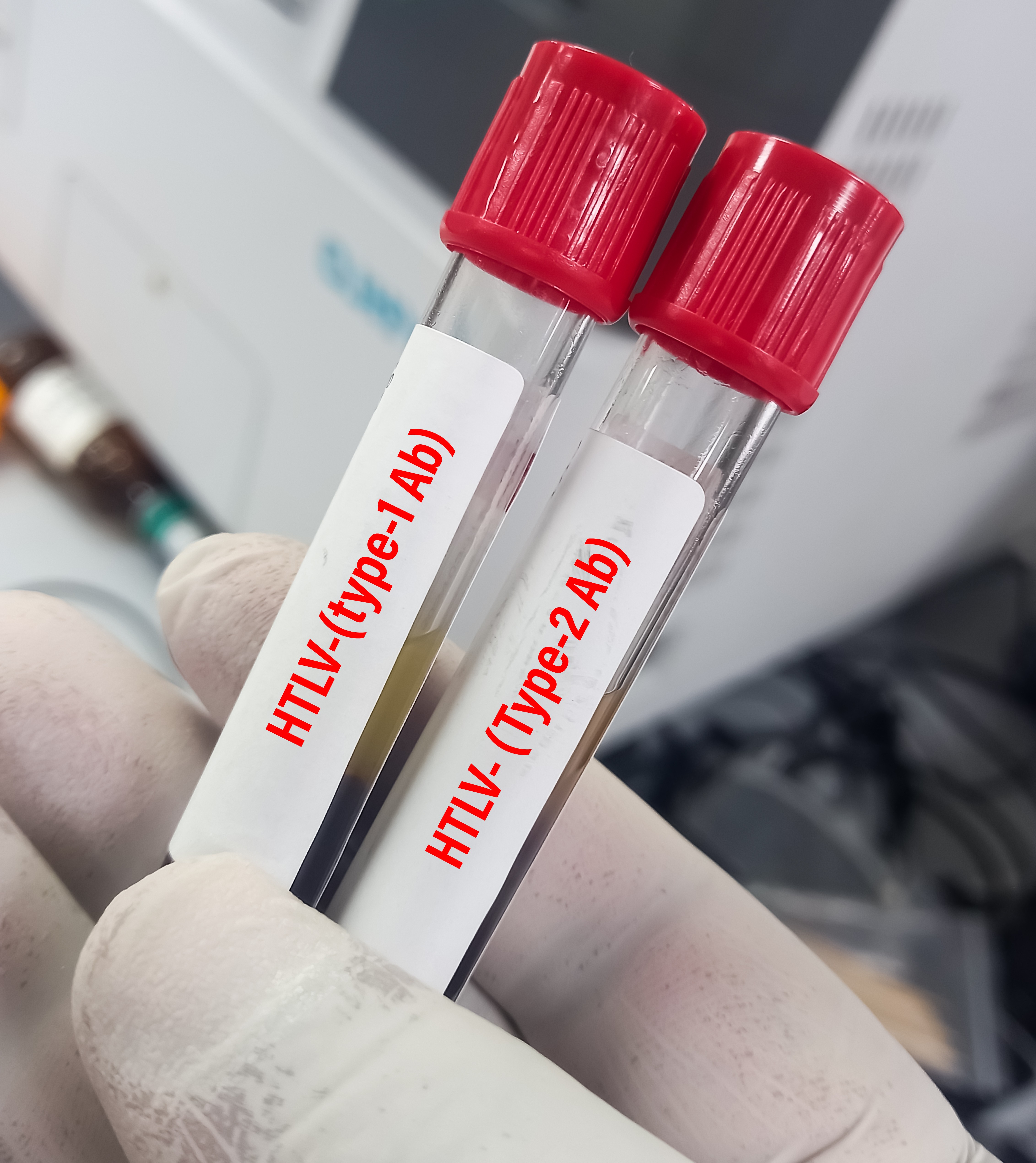 Fiocruz lidera estudo que usa vírus HTLV-1 para investigar Esclerose Múltipla progressiva