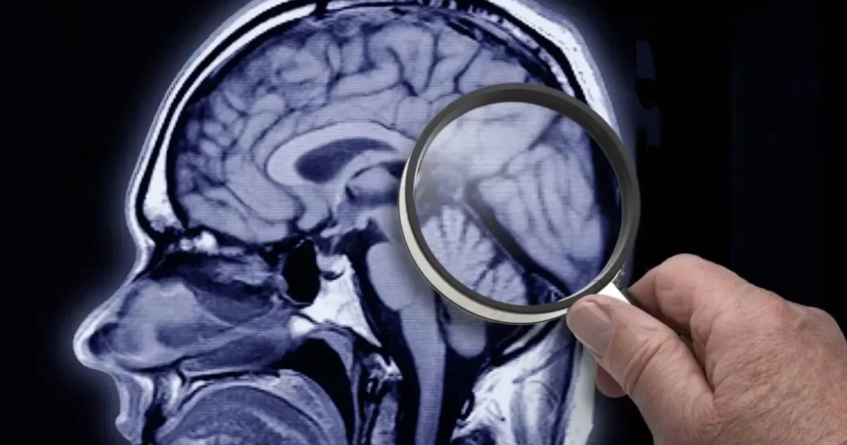 Proteína Arc é identificada como chave para aceleração do Alzheimer