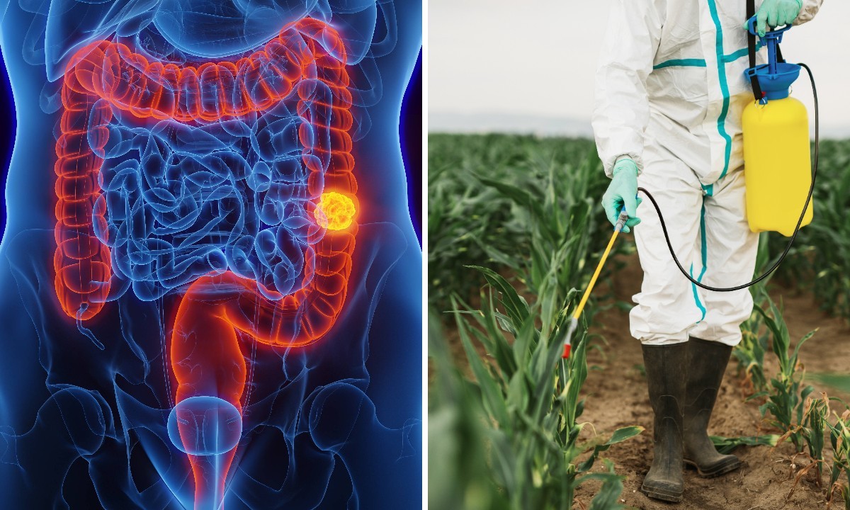 Câncer colorretal em jovens: estudo aponta herbicida