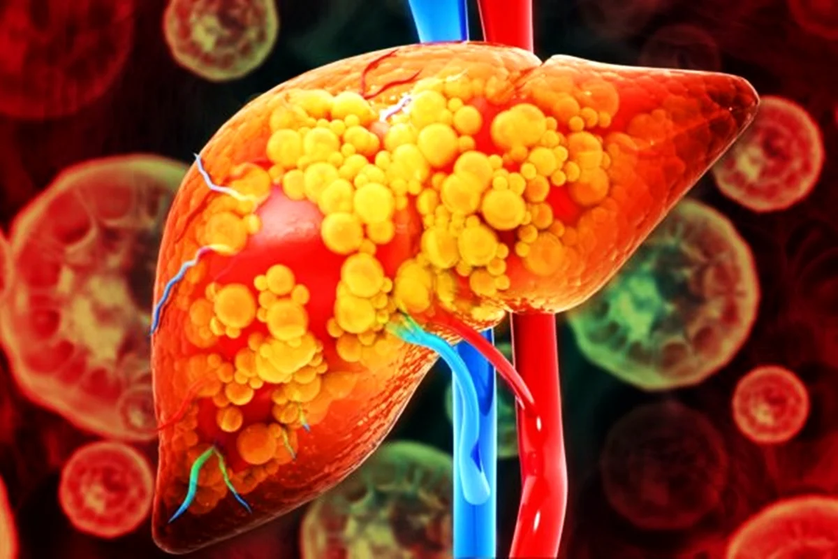 Gastroenterologista alerta para sinais silenciosos da gordura no fígado