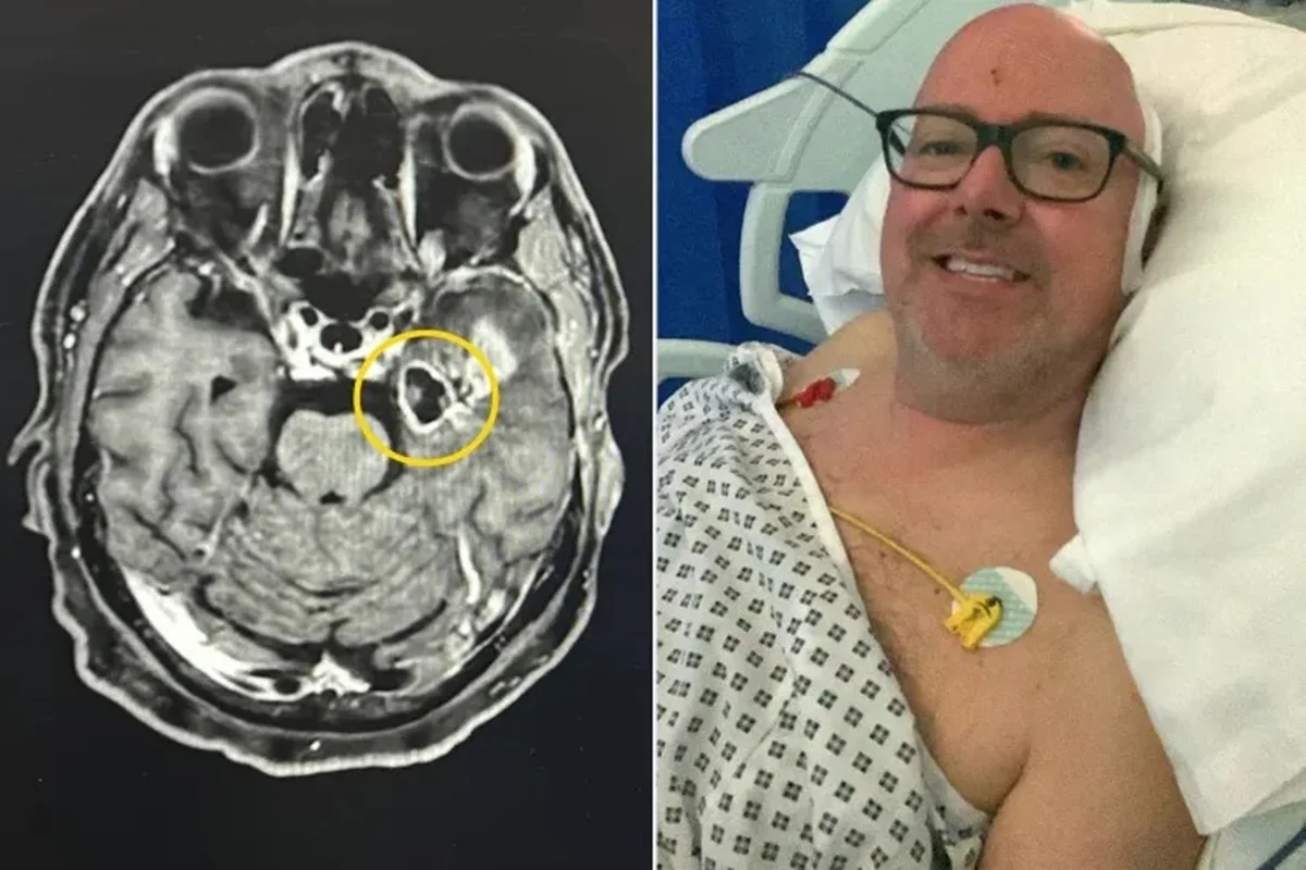 Homem descobre tumor cerebral agressivo após confundir tontura com abstinência