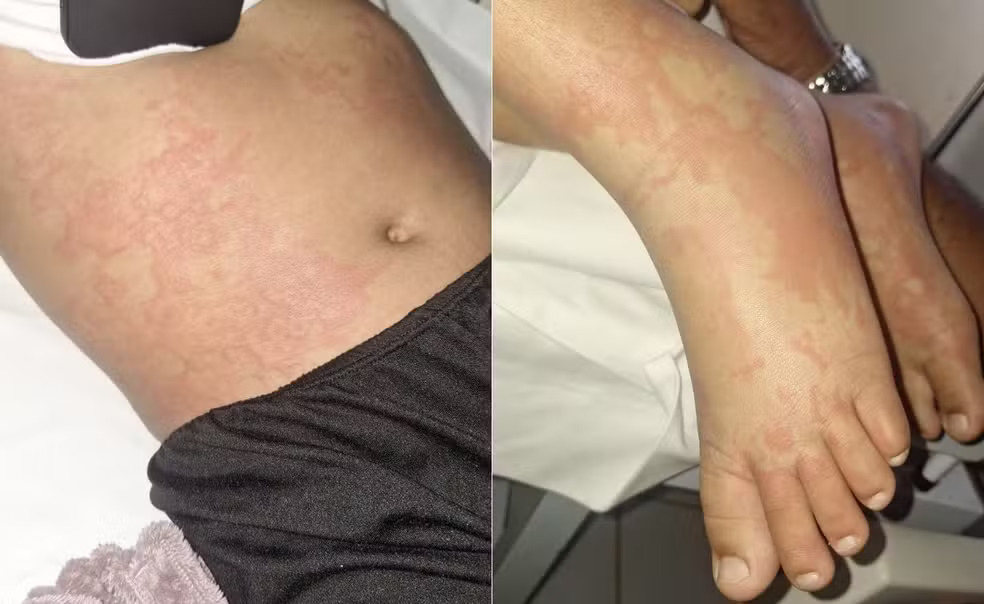 Anvisa investiga caso de menina intoxicada por detergente suspenso