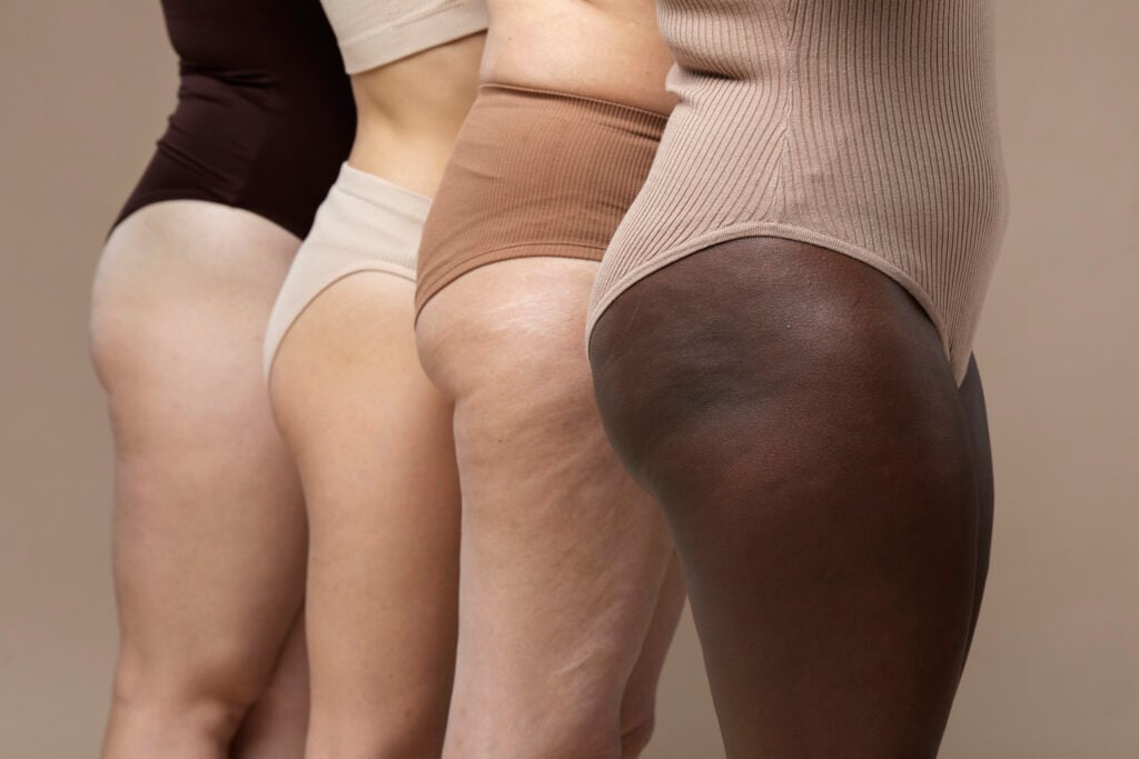 Lipedema: Cirurgiã plástica desmistifica e classifica como doença no SPIW