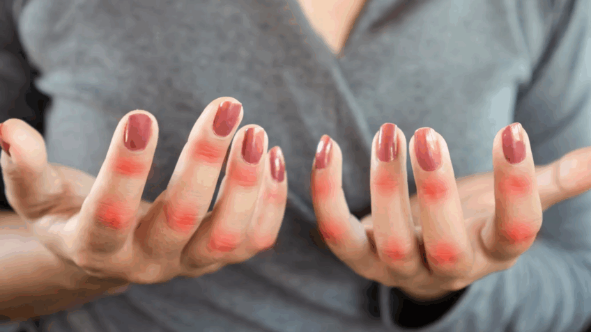 Lúpus desativa defesa do corpo, revelam estudos internacionais