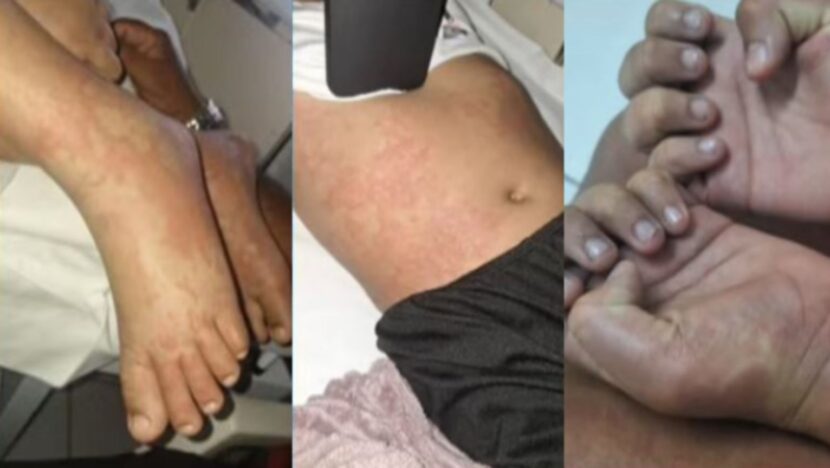 Kleber Luz aponta que quadro de menina não é de infecção por detergente