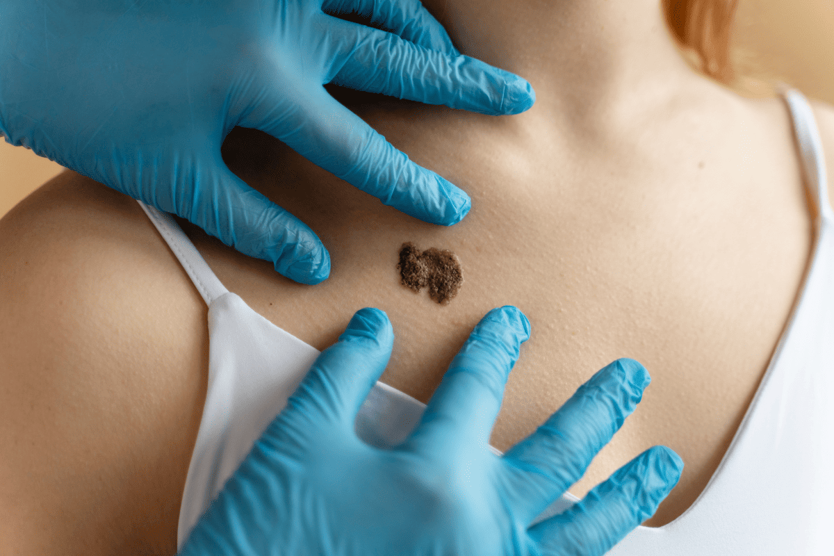 Cristina Salaro detalha como prevenir e identificar o melanoma